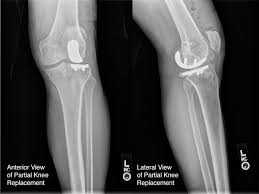 Knee Replacement in Lahore: The Ultimate Guide to Regain Mobility