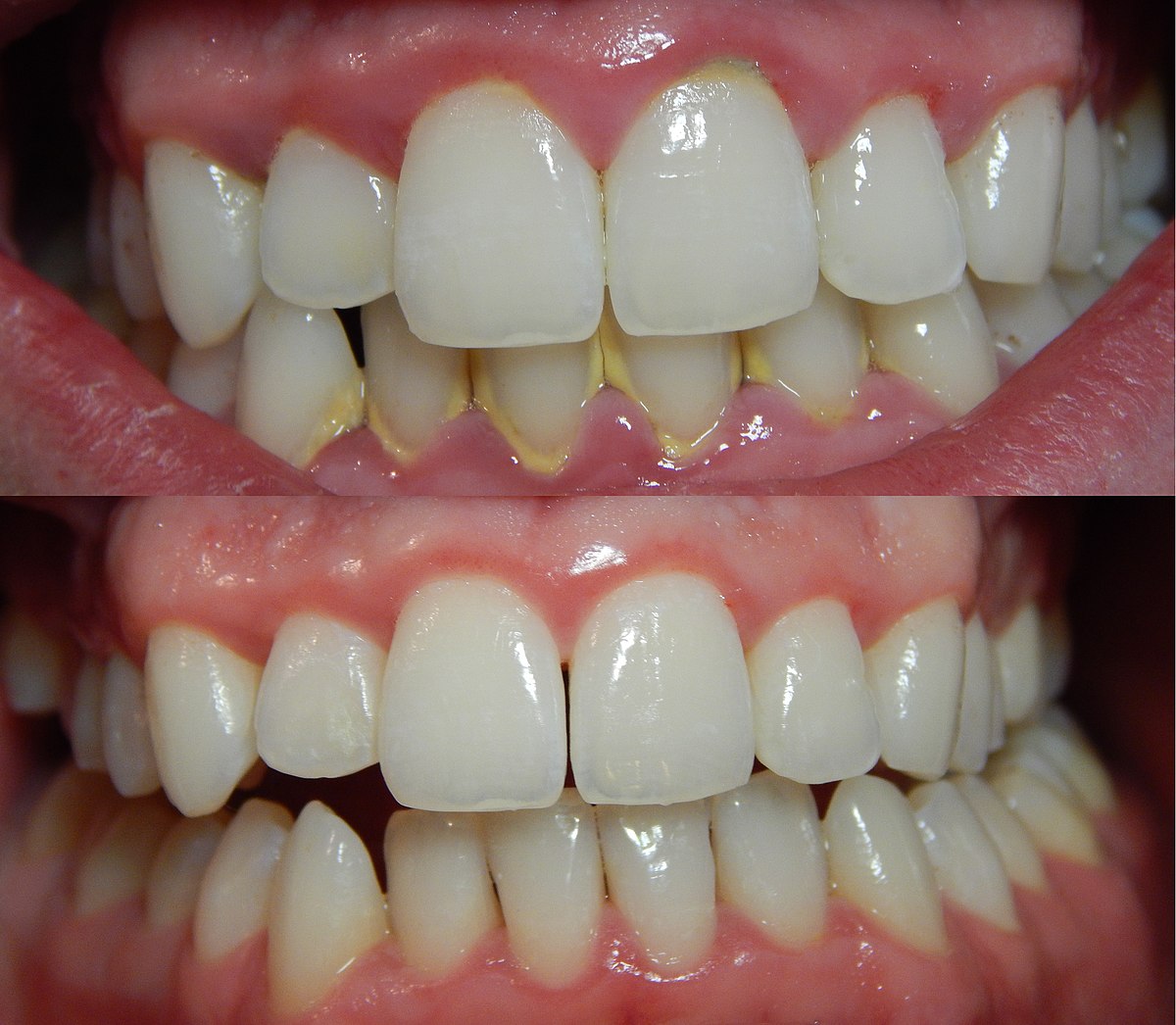 Can I brush my teeth after scaling?