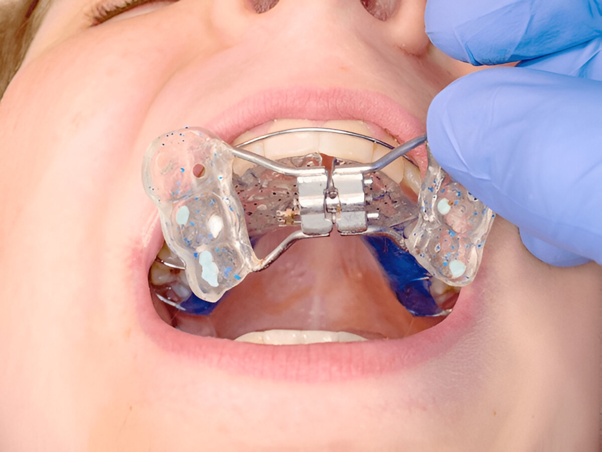 Eating with a Palatal Expander: What to Expect & How to Adjust