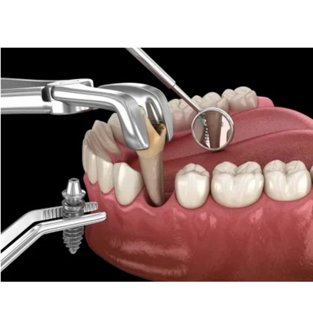 Tooth Extraction Clinic Near You &ndash; Quick & Comfortable Removal