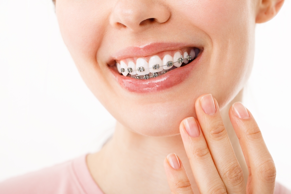 The Role of Braces in Treating Crossbites and Open Bites