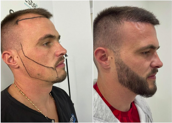 Everything You Should Know About Getting a Beard Transplant in London