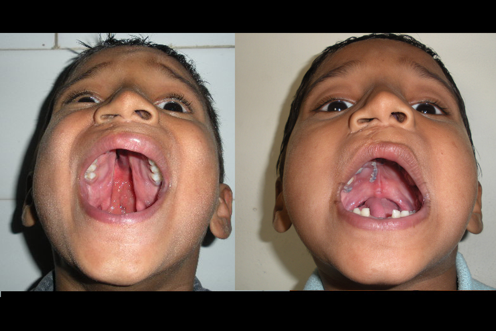 Comprehensive Cleft and Palate Care by India’s Maxillofacial Specialists