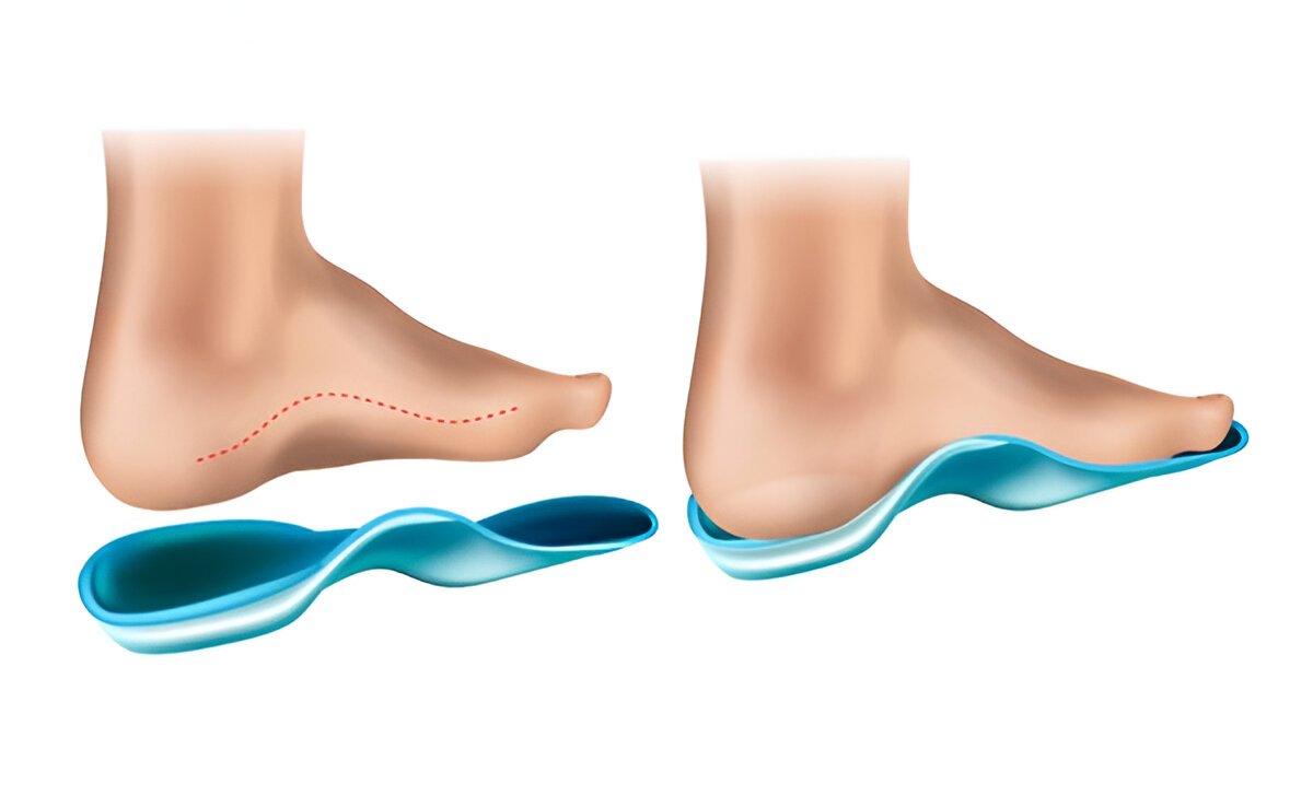 Arch Insoles for Flat Feet in Chennai: Why They’re Essential for Daily Comfort and Support