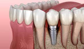 Surgical Tooth Extraction Cost Explained
