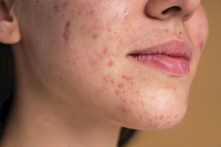 Manchester’s Best Acne Treatments for Clear, Healthy Skin