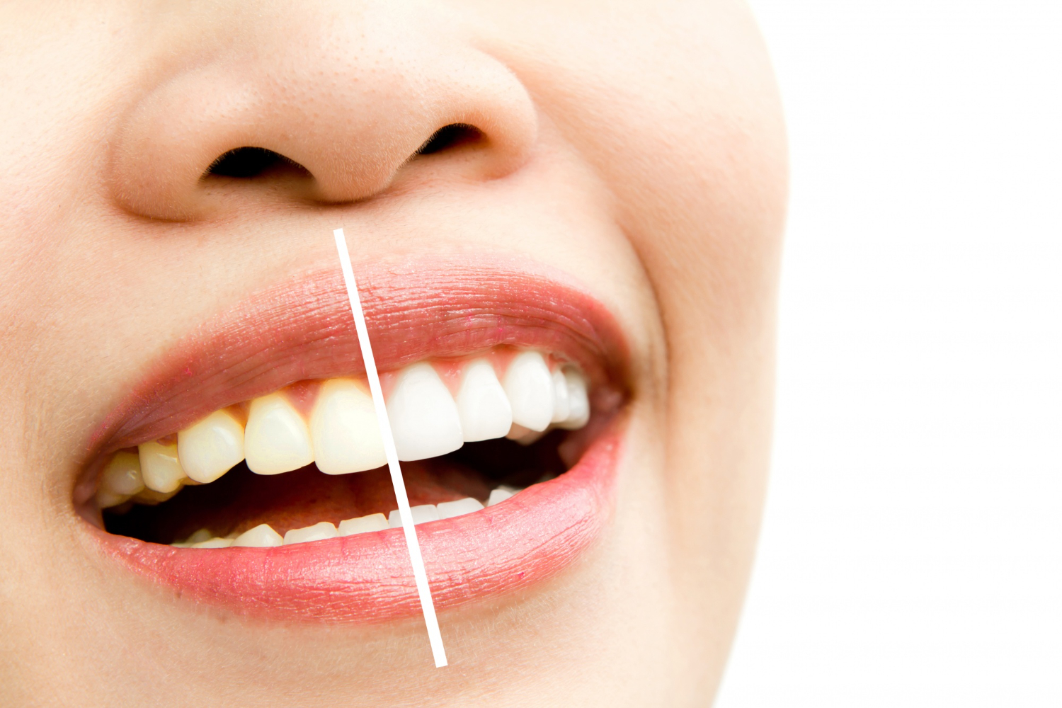 Transform Your Confidence with Smile Design at Smritiraj Dentistry, Dwarka