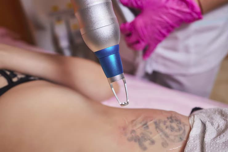 How Tattoo Removal Works: Leeds Specialists Share Insights