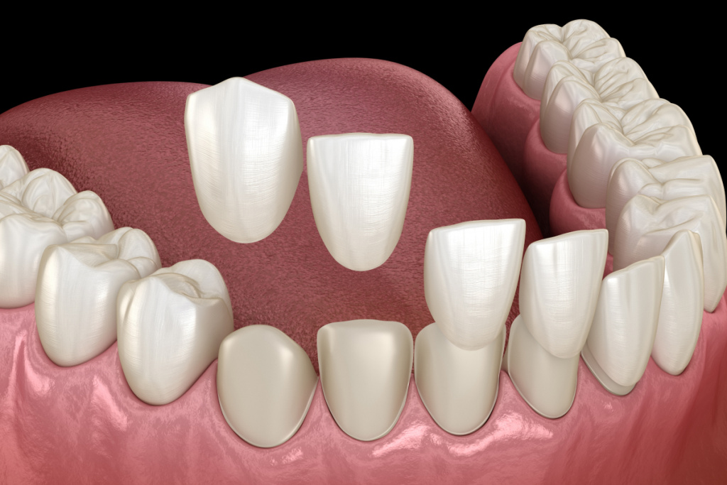 Is enamel removed for composite veneers?