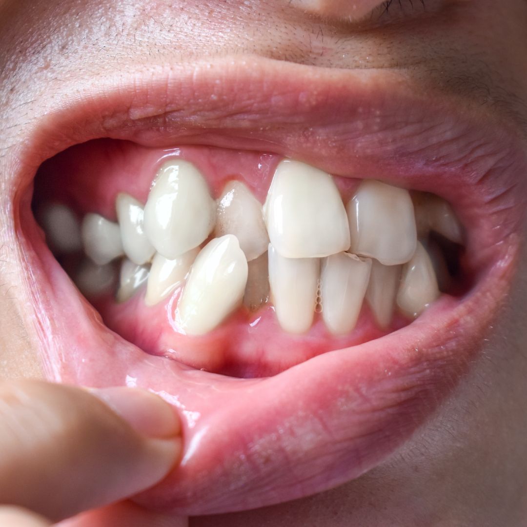 How to Fix Buck Teeth in Children: Early Treatment Tips for Parents