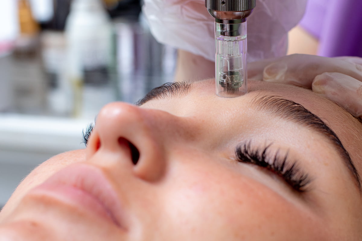 How Microneedling Works: Benefits for Skin Health