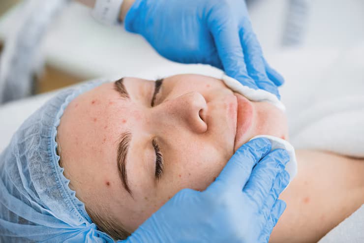 Treating Dark Spots: Birmingham Hyperpigmentation Clinics Explained