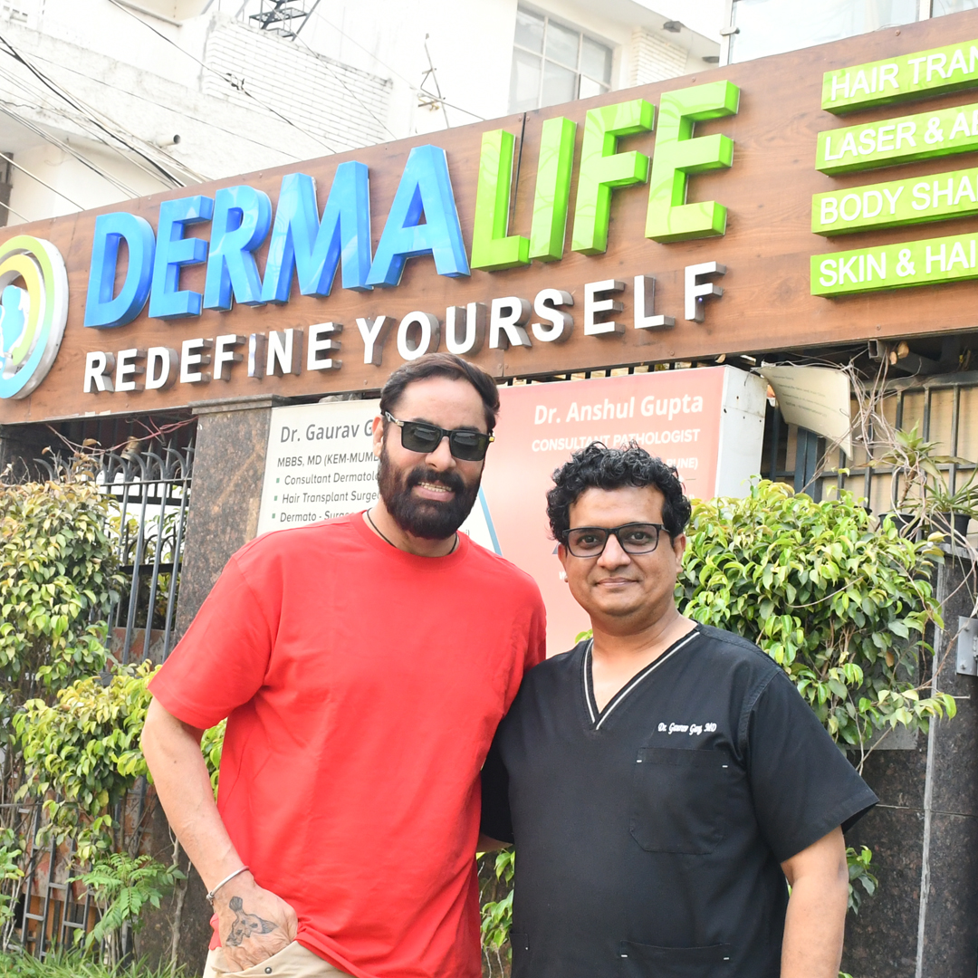 Hair Transplant in Delhi: Side Effects You Should Know