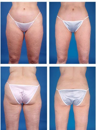 Liposuction NYC: Your Comprehensive Guide to Body Contouring in New York