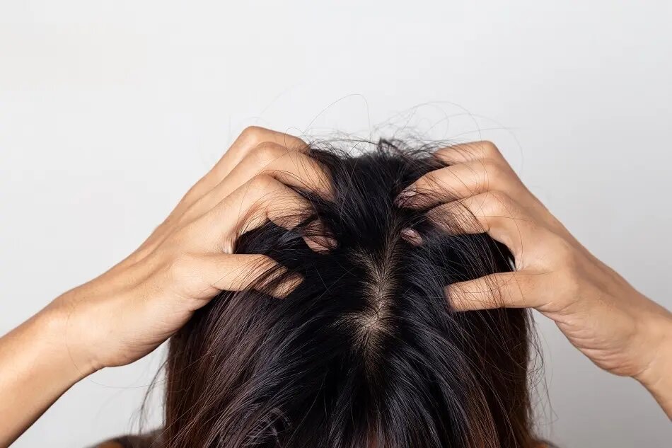 Head Lice? Don’t Panic — The Simple Way to Get Rid of Them for Good