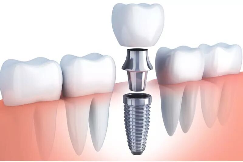 Dental Implants London, Ontario: From Procedures to Advantages
