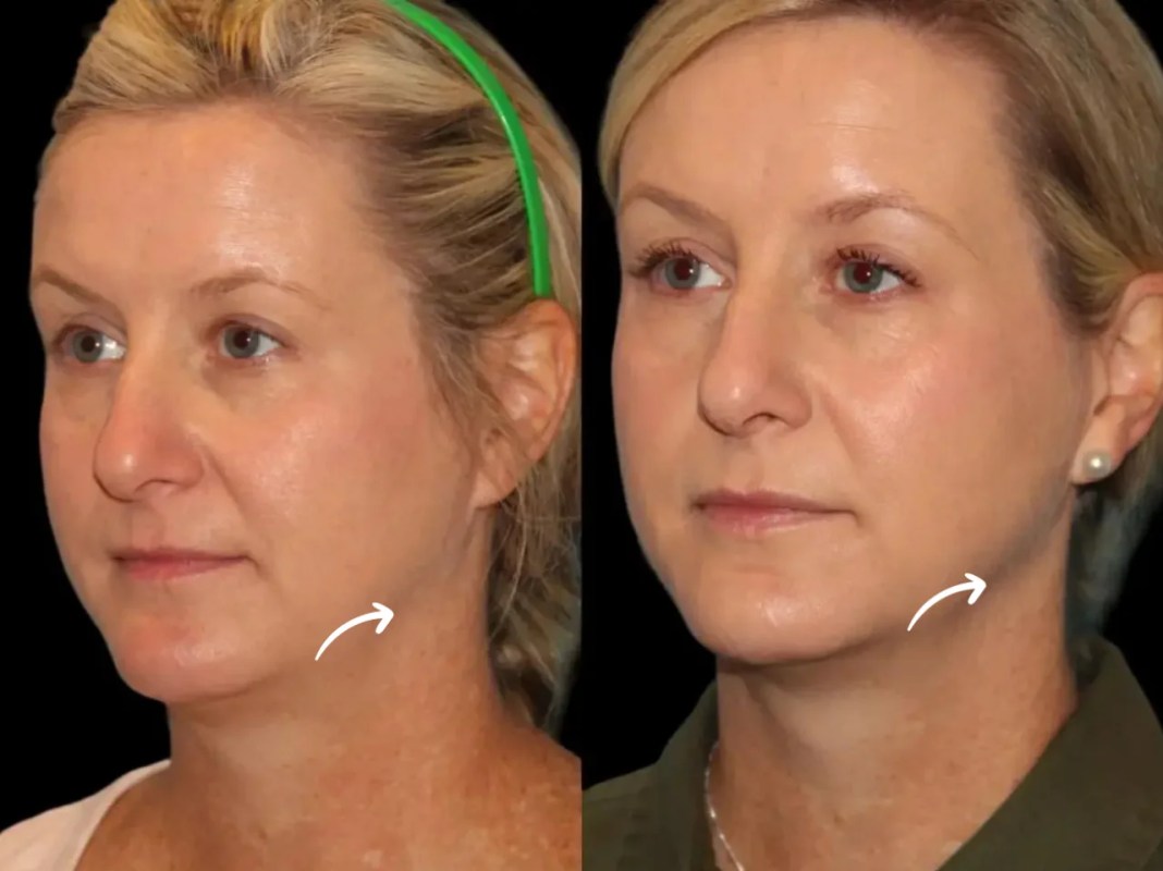 Top Reasons the Best Doctors in Dubai Love Sculptra Fillers for Subtle Rejuvenation