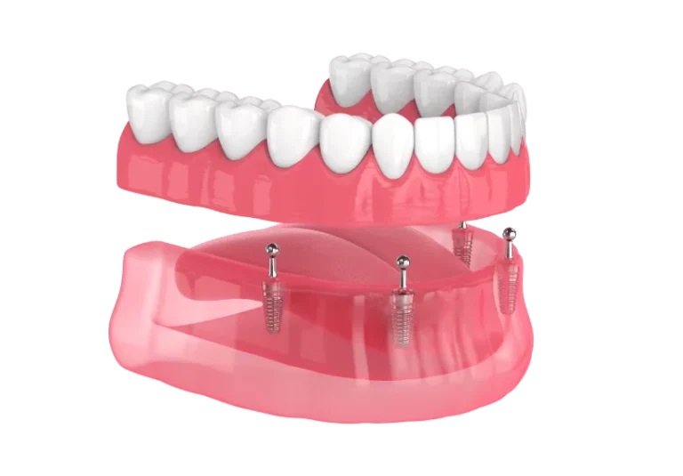 Smile with Confidence: Why Dental Implants in Brisbane Are the Gold Standard for Tooth Replacement