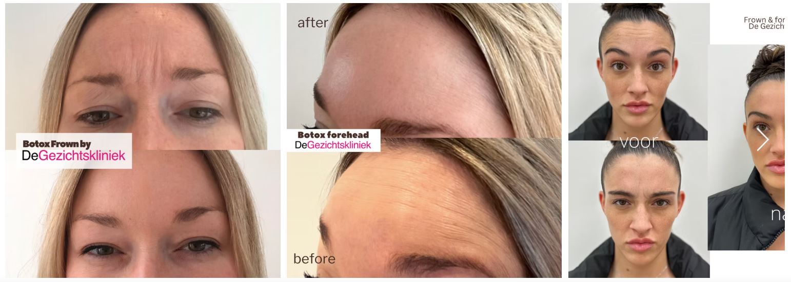 What Really Happens When You Get Botox? The Science Behind Smoothing Wrinkles