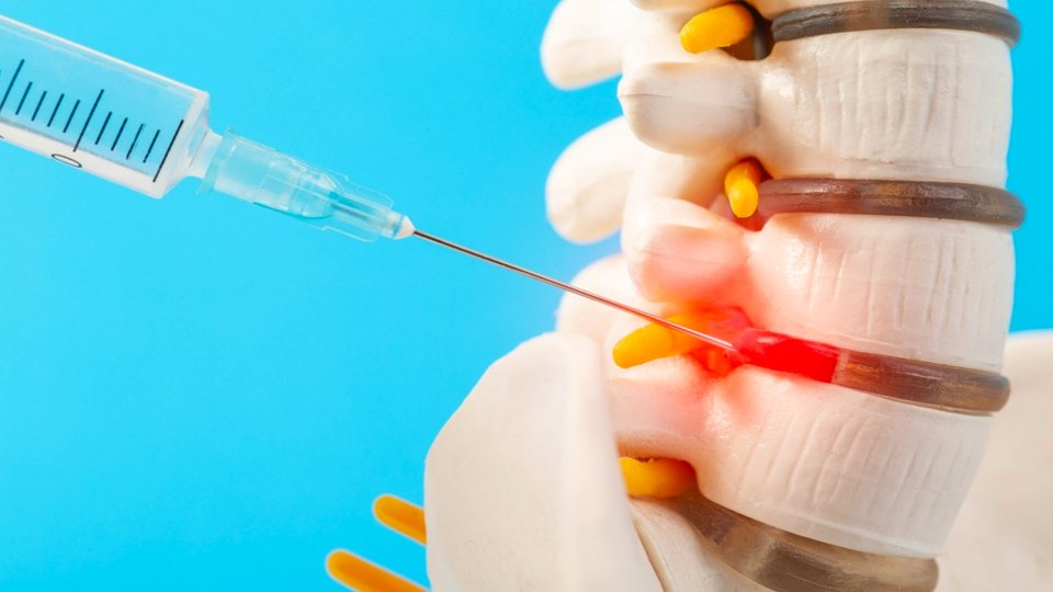 Epidural Steroid Injections: Efficacy in Older Adults