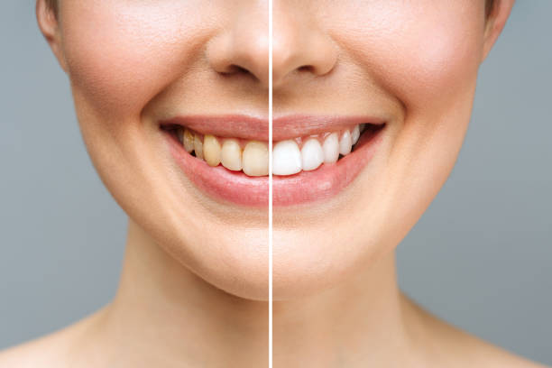 An Explanation Of The Entire Teeth-Whitening Procedure In London, Ontario