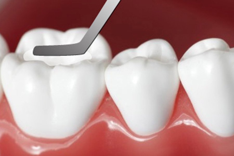 Trám răng có lâu không? Giải đáp từ chuyên gia và cách rút ngắn thời gian hiệu quả