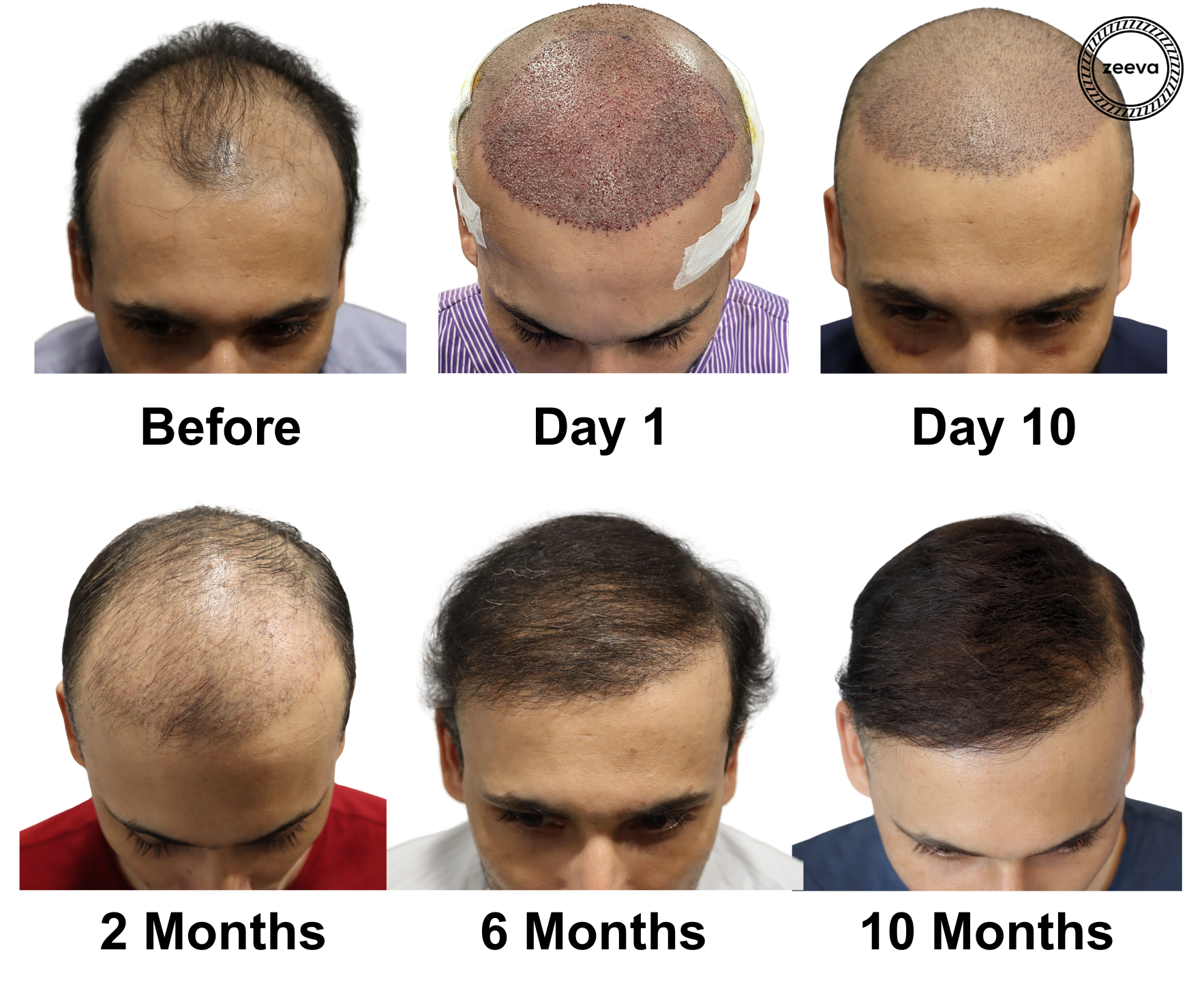 Regrow Your Hair – Top Hair Experts in Ahmedabad