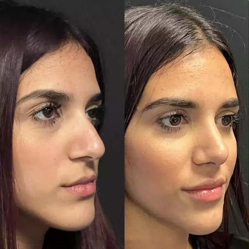 Choosing the Best Doctors in Dubai for Functional Nasal Surgery