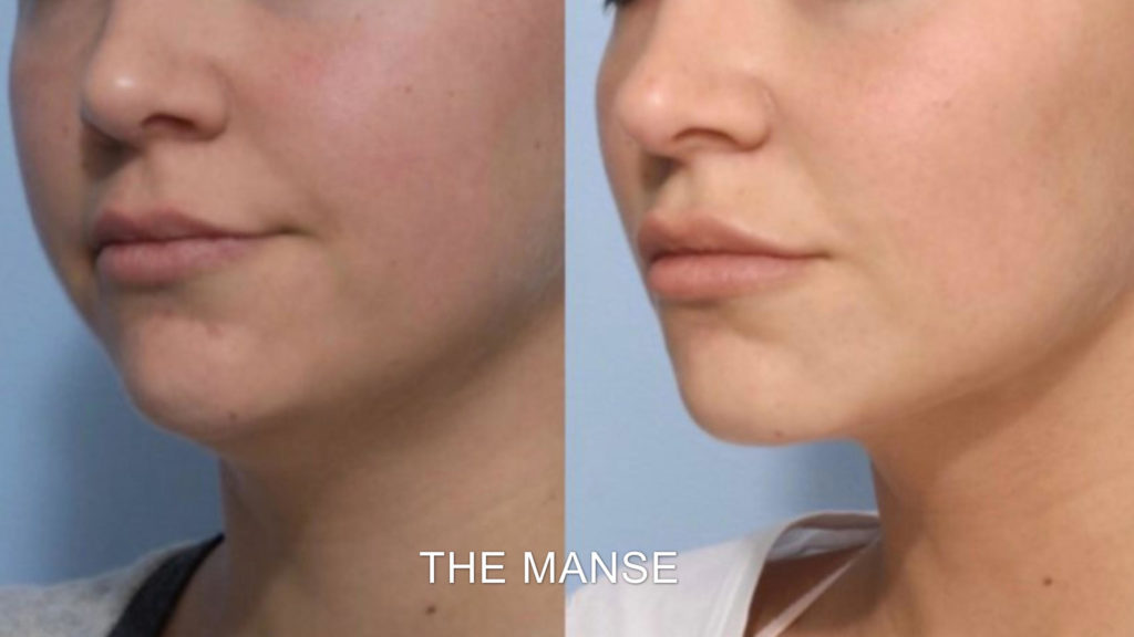 The Best Jaw Filler Offers in the East Midlands This Month