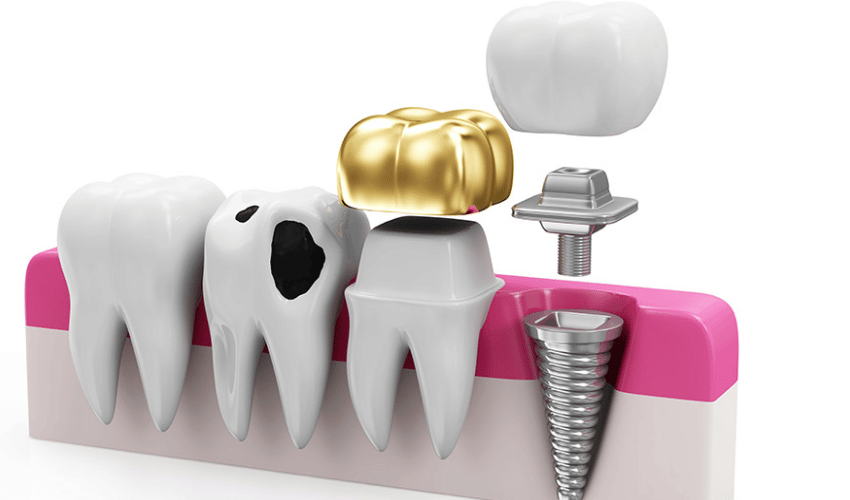 Book Restorative Dentistry Services in Mississauga – Restore Your Smile Today