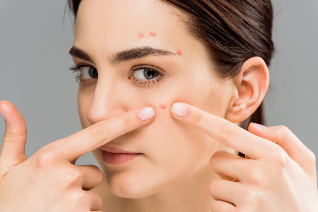 A Brighter Complexion with Acne Solutions in Dubai