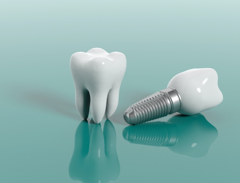 What are the three major parts of a dental implant?