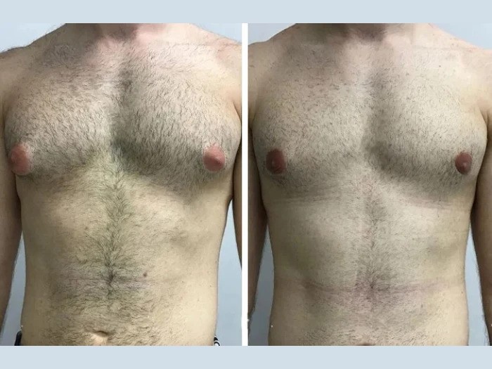 Gynecomastia in Dubai: A Growing Trend Among Young Professionals