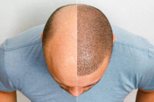 FUE Hair Transplant in Riyadh: Is It Right for You?