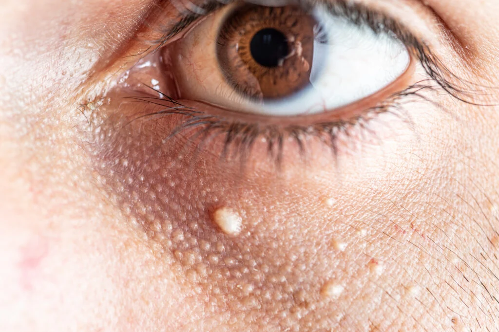 What’s the Success Rate of Milia Treatment?