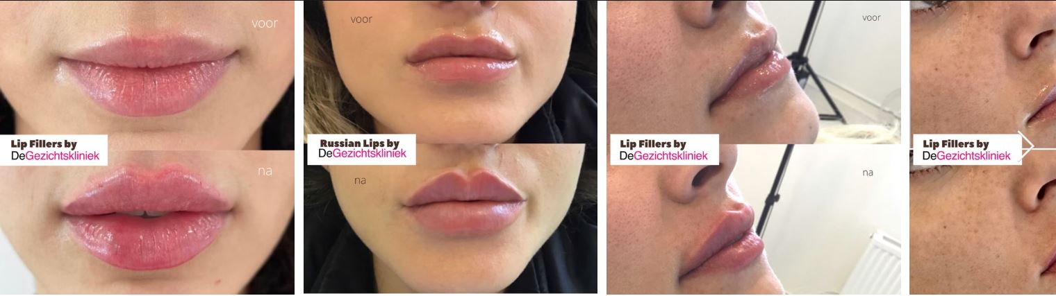 Thinking About Botox or Fillers in Eindhoven? Here&rsquo;s Why Local Expertise Really Matters