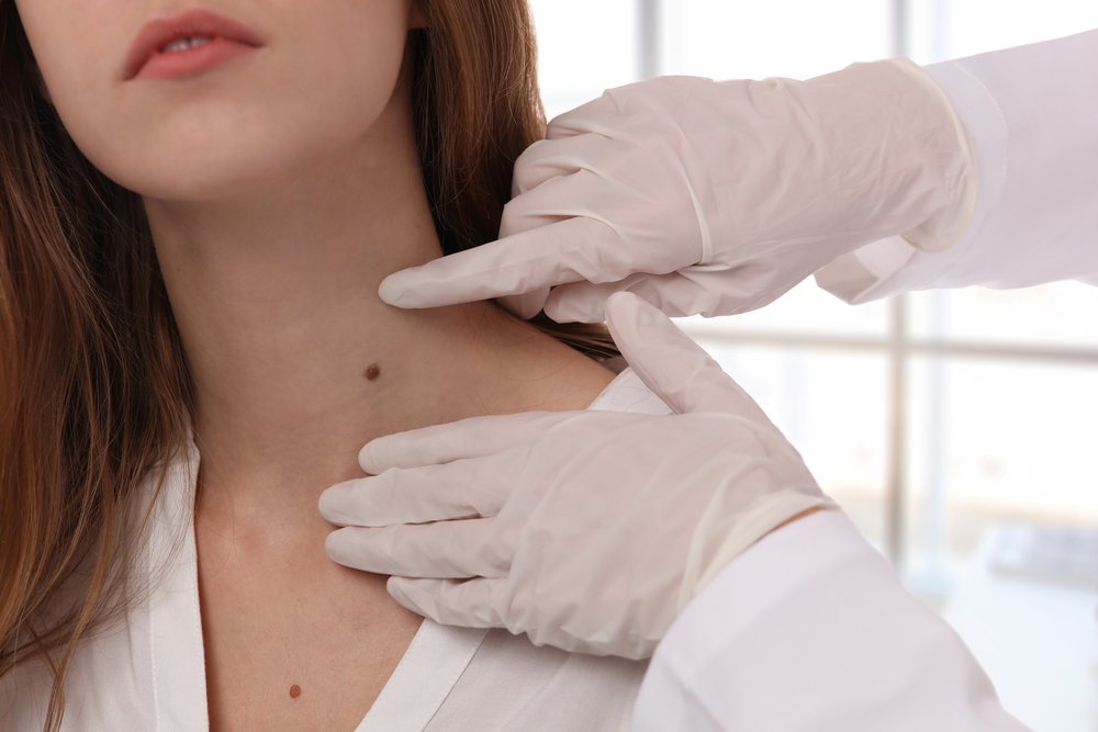 Is Mole Removal Safe for Older Adults?