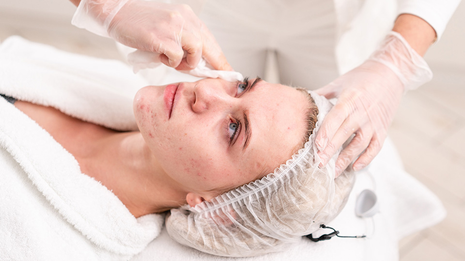 Top 10 Acne Solutions in Dubai