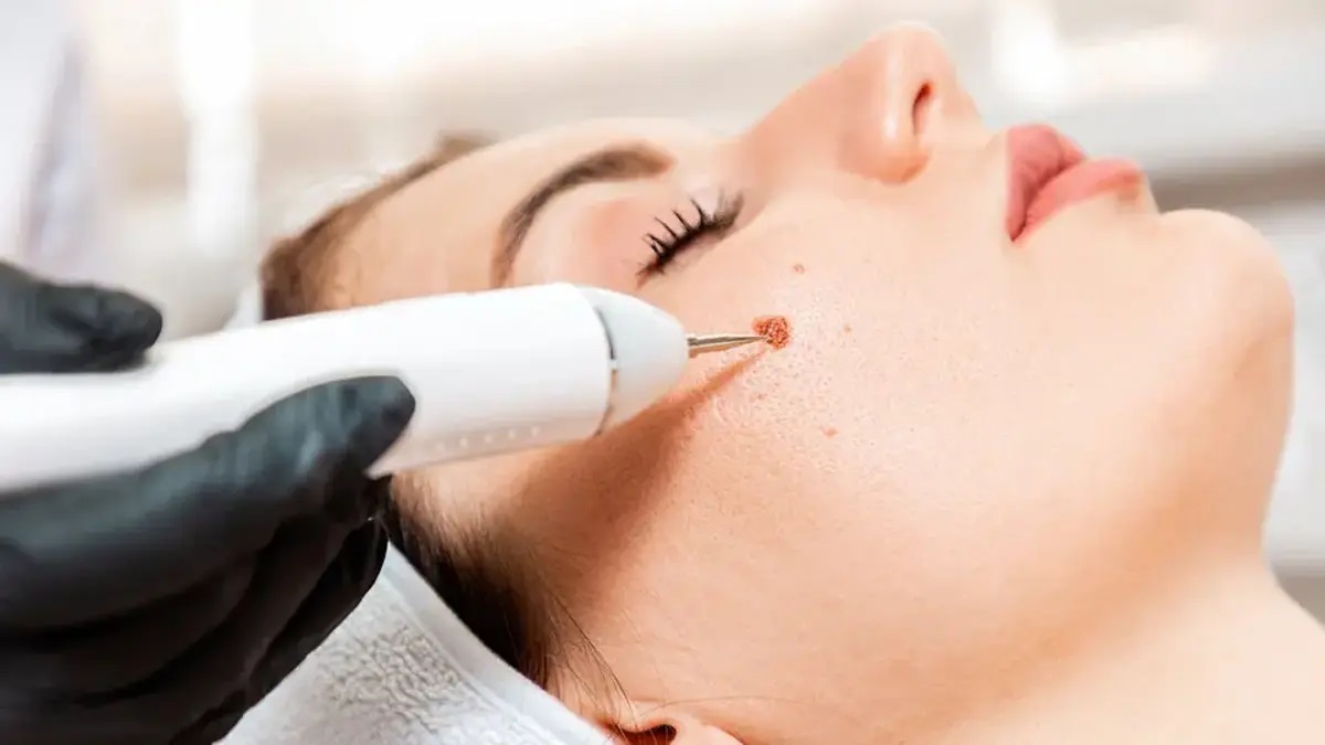 What happens if warts are not removed?