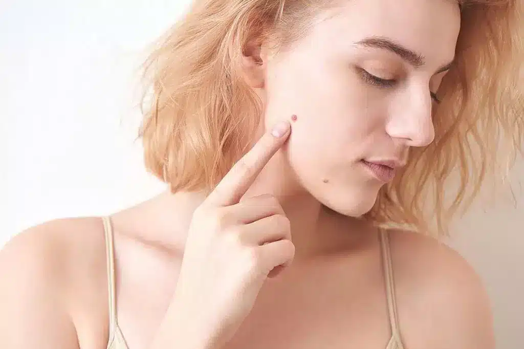 Laser Warts Removal: Safe & Effective Treatment