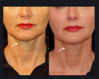 Best Plastic Surgeon in Dubai for Skin Tightening with Sculptra Fillers Boosters