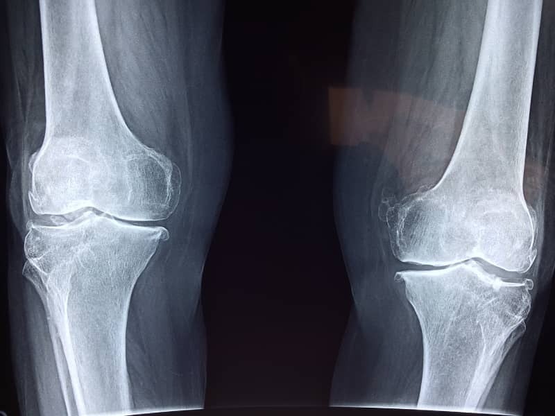 Effective Knee Pain Treatment in Lahore: Top Solutions for Relief and Recovery