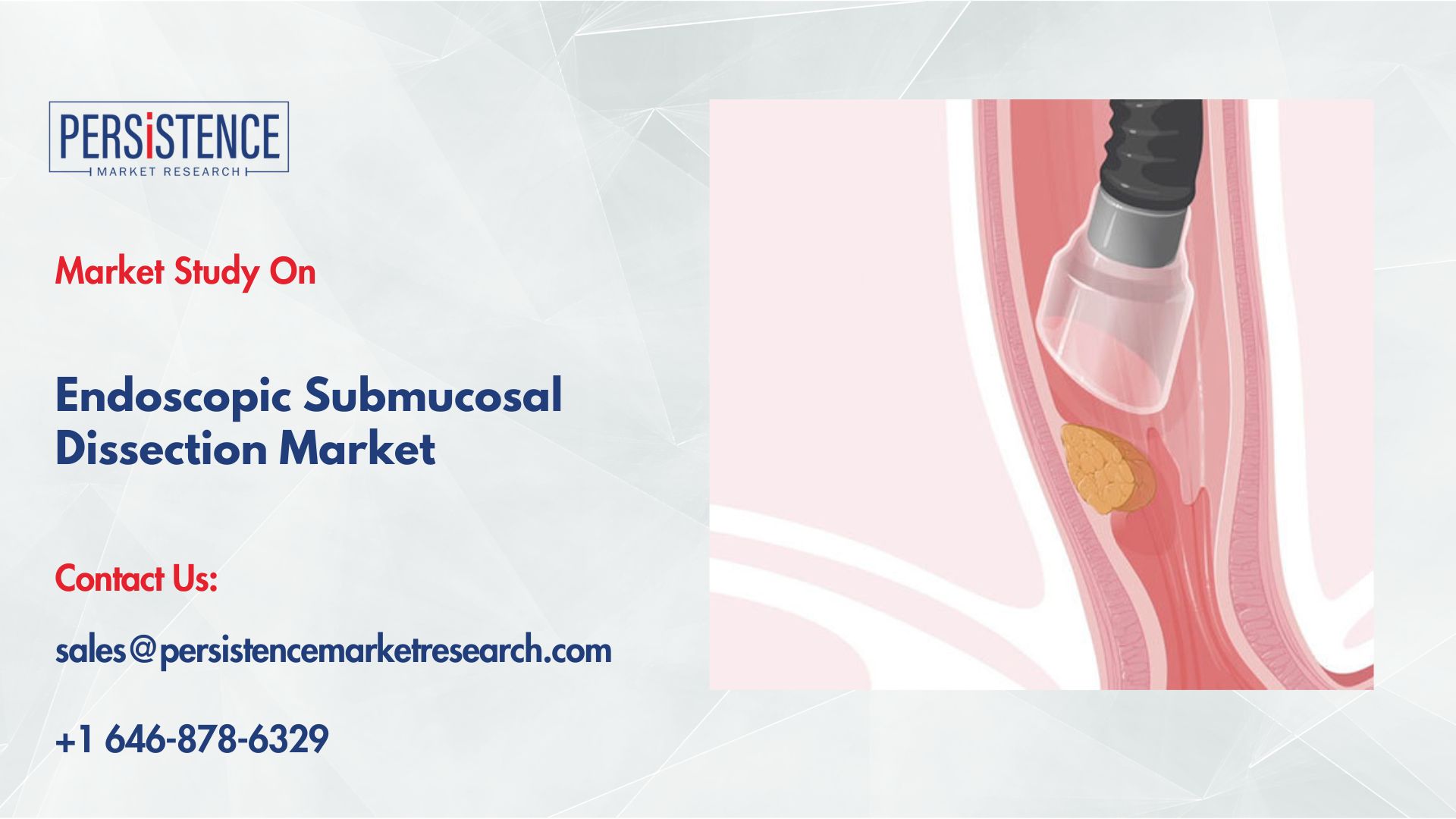 The Endoscopic Submucosal Dissection Industry is Booming | News & Insights