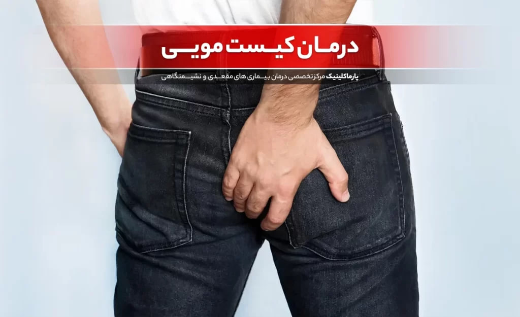 Pilonidal Cyst Treatment at Parma Clinic + Cost