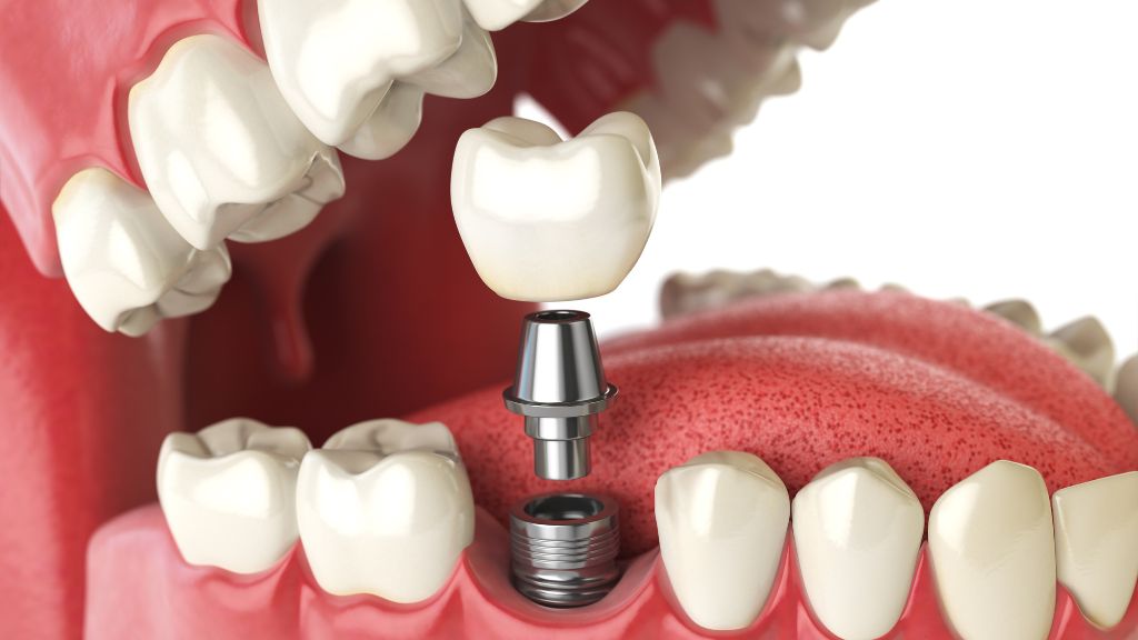 Full Mouth Dental Implants: Procedure and Costs