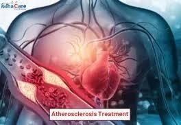 Comprehensive Atherosclerosis Treatment in India with EdhaCare