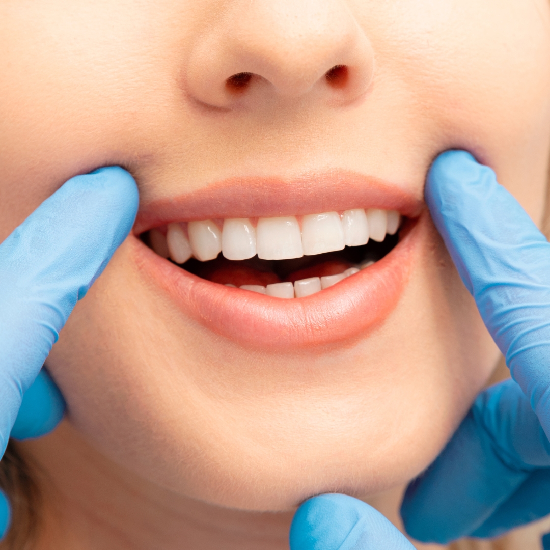 Professional Teeth Whitening Cost: What to Expect Before Your Visit