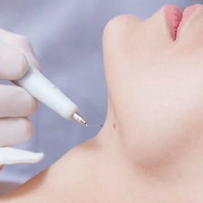 How Long Does Wart Removal Take in Dubai Clinics?