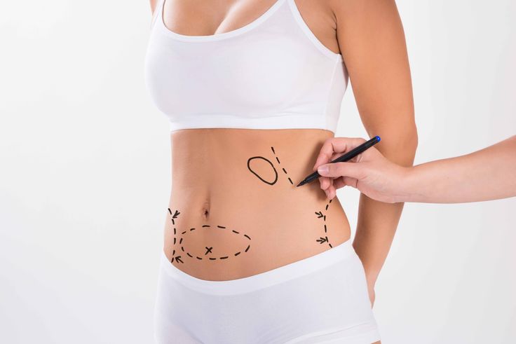 Liposuction for Men in Islamabad: What Are the Options?