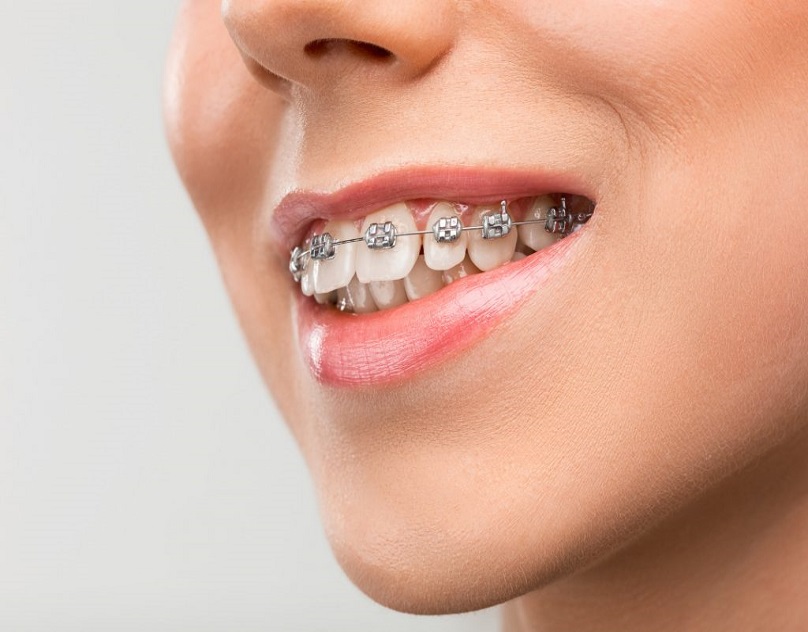 From Consultation to Retainers: Braces in Dubai